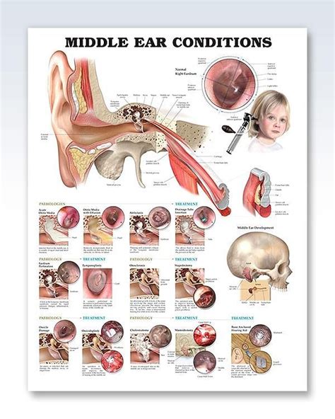 Middle Ear Conditions 20x26 Anatomy Poster Middle Ear Ear Anatomy