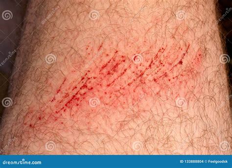 Scratch Skin Wound Or Cut On The Skin Red Blood Hairy Part Of A Man