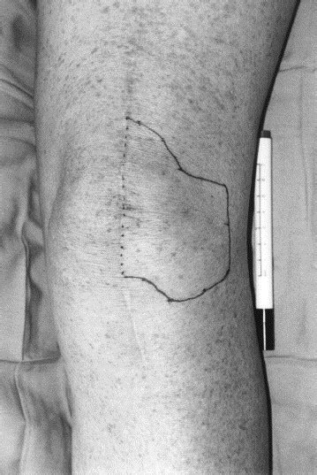 Reducing Lateral Skin Flap Numbness After Total Knee Arthroplasty The