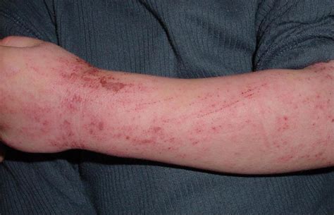 Skin Irritation And Redness On Arms Causes And Treatment Heidi Salon