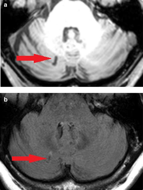 Cerebellar Lacunar Infarct A T1 And B Flair Example Image Of A
