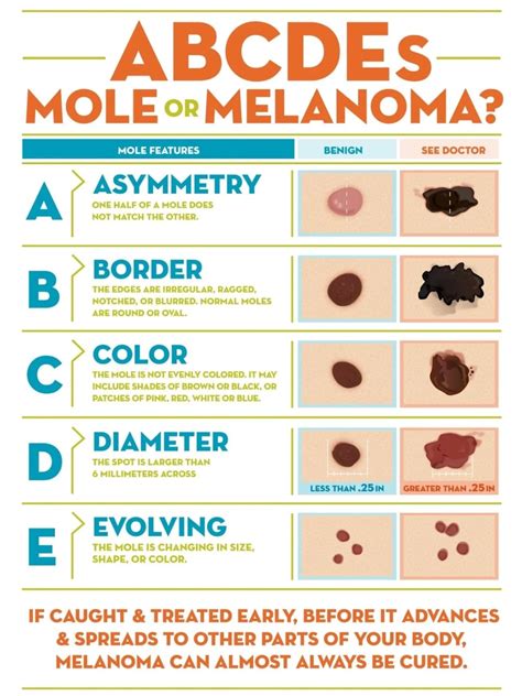 Know Your Moles Dermatology Care Of Charlotte