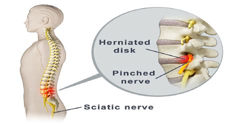 Try These 2 Highly Effective Solutions To Release The Pinched Nerve In The Lumbar Area And