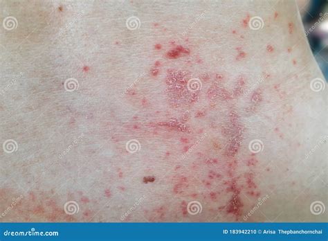 Heat Rash Hives Allergy Reaction Knee Close Up Reference Picture Of