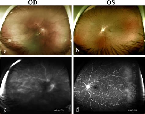 Fundus Photographs And Fundus Fluorescein Angiography Fa The Fundus