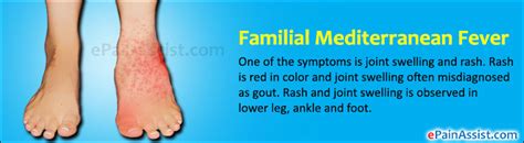 Familial Mediterranean Fever Fmfetiologyrisk Factorssignssymptoms