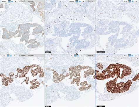 Vimentin was positive for sarcomatoid components of mpm. Pathology Outlines - BerEP4 / EpCAM