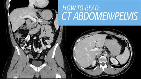 How To Read A Ct Abdomen And Pelvis Like A Radiologist Introductory