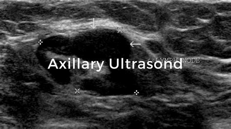 Axillary Ultrasound Breast Cancer School For Patients