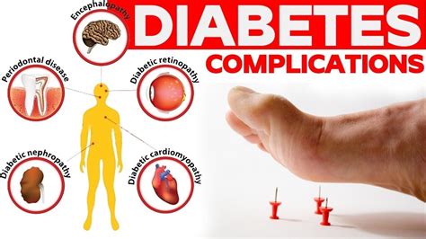 Other Complications Of Diabetes Diet Of Diabetes How To Control