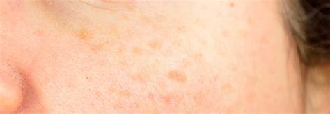 Sun Damaged Skin Treatment Vitalskin Dermatology