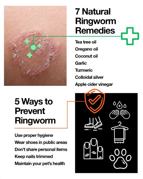 Ringworm Signs