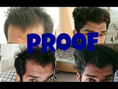 Divide your hair and clip it into sections. Proof of hair regrow naturally - YouTube