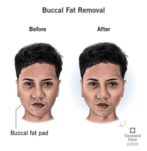 Buccal Fat Removal What It Is Recovery And Before And After