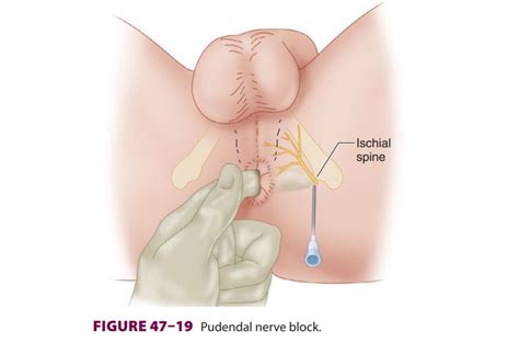 Ischial Spine Pudendal Nerve