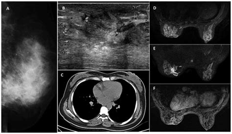 Breast Panniculitis With Liquefactive Fat Necrosis A Case Report
