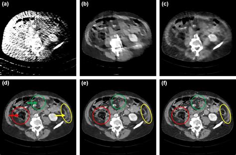 Figure 1 From AI Enabled Ultra Low Dose CT Reconstruction Semantic