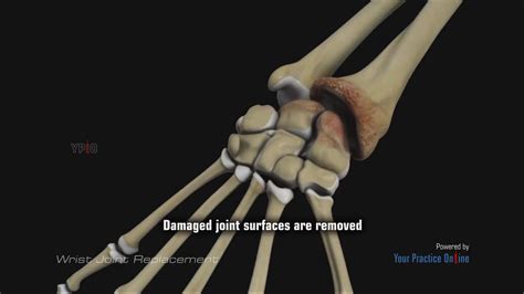 Wrist Joint Replacement Video Medical Video Library