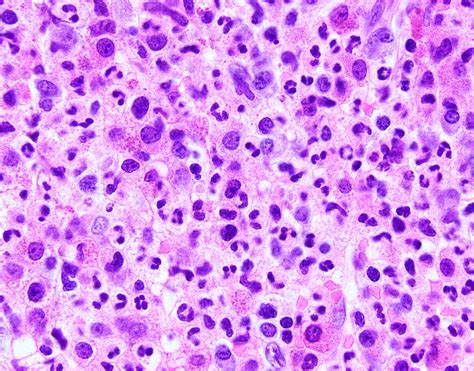 Pathology Outlines Chronic Neutrophilic Leukemia