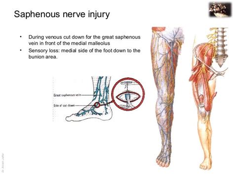 Applied Anatomy Saphenous Nerve Injury