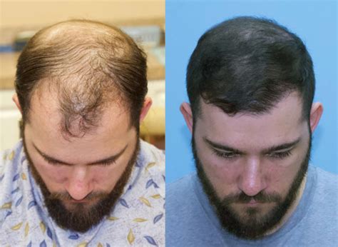 Fast Results After Fue Grafts Transplanted Carolina Hair Surgery