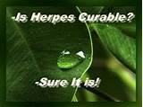 Pictures of Holistic Cures For Genital Herpes