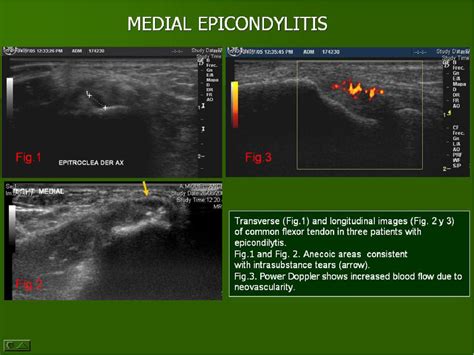 Figure 21 From Ultrasound Of The Elbow What The Radiologist Should