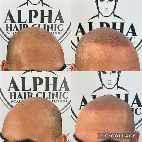 Scalp Micropigmentation Training Alpha Hair Clinic