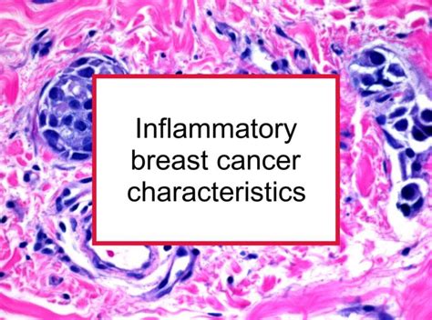 Inflammatory Breast Cancer Best Health Guide 2023 Ehealth Magazine