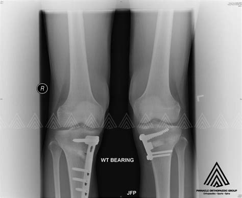 Knee Osteotomy Singapore Surgeon Delay Joint Replacement