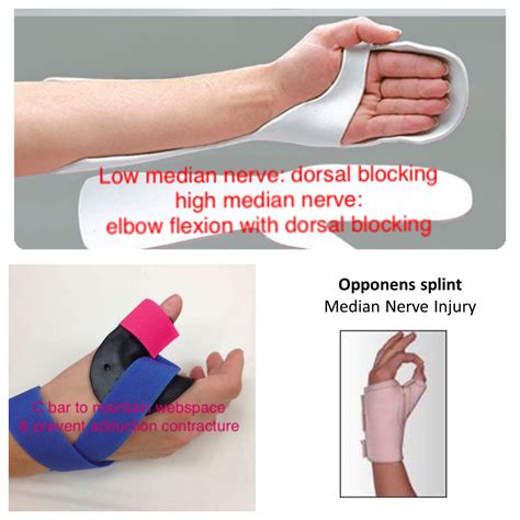 Median Nerve Injuries Low Loss Of Thumb Opposition And Abduction With