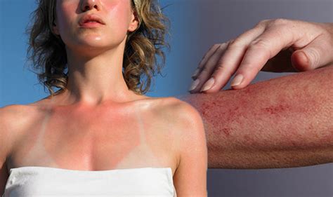 A heat rash generally shows up on the trunk of your body, your chest, or your arms, chaiyasit says. How to get rid of prickly heat: Three ways to calm itchy ...