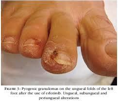 An eleven year retrospective analysis of early recognition, diagnosis, and treatment. Hidradenitis suppurativa | Italy| PDF | PPT| Case Reports | Symptoms | Treatment