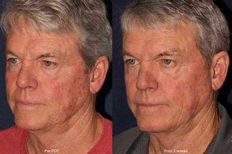 Photodynamic Therapy Pdt San Diego Ca Cosmetic Laser Dermatology