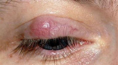 Ingrown Eyelashes How To Remove Get Rid Upper Lower Eyelid Stye