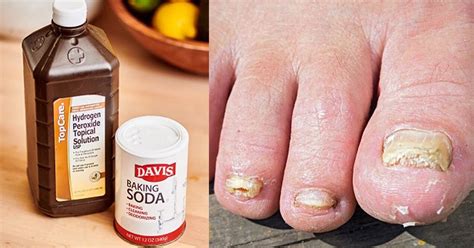 Baking Soda And Hydrogen Peroxide For Toenail Fungus Recipe And Tips