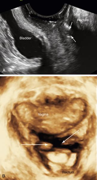 Vaginal Masses Clinical Gate