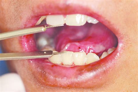 Procedure Used For The Measurement Of Mouth Opening Download