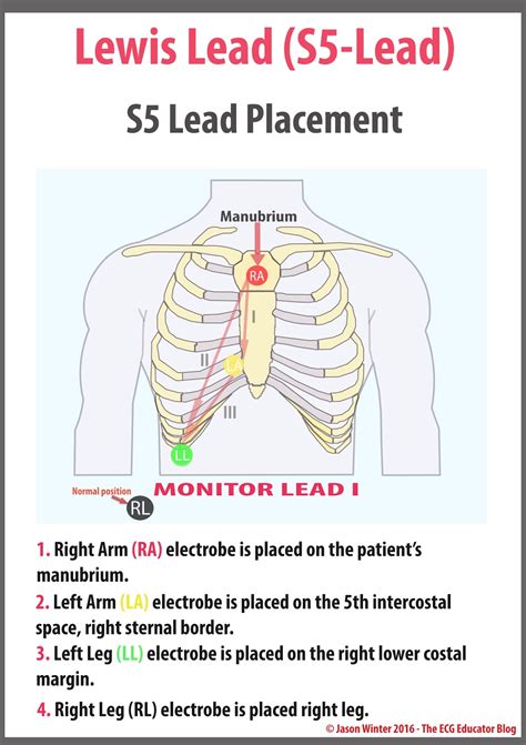 15 Lead Ecg Placement Diagram