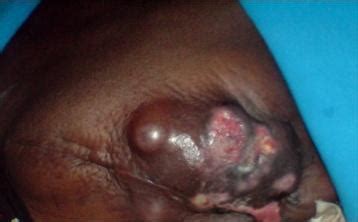 Weber b.// biology of herpes virus infections and tagers of anti viral therapies int. Wounds - anamed edition