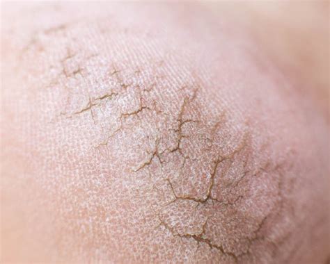 Dry Cracked Skin On The Heels Of A Person S Legs Close Up Concept Of