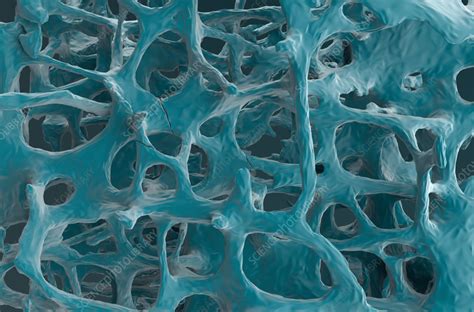 Fractures In Osteoporotic Bone Tissue Illustration Stock Image