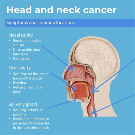 Head And Neck Cancer Infographic Oncology Central