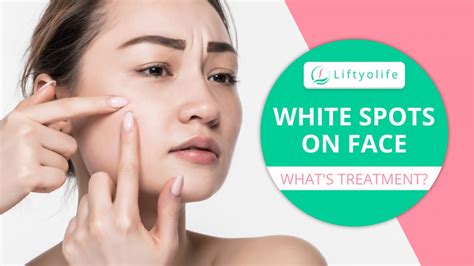 Causes Of White Spots On Face Treatment Liftyolife Com