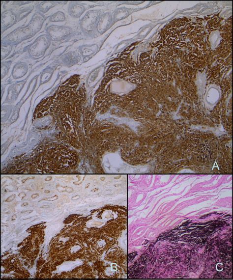 Immuno Histological Profile By Ps100 A Melan A B Two Markers Of