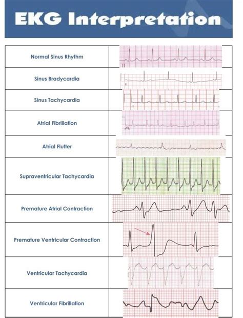 Common Ekg Heart Rhythms Nurse Cardiac Nursing Ekg Interpretation