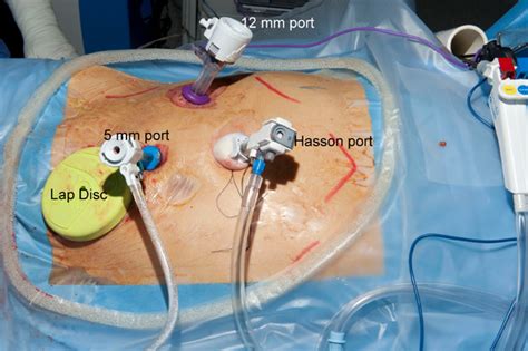 Laparoscopic Kidney Transplant By Extra Peritoneal Approach The Safe