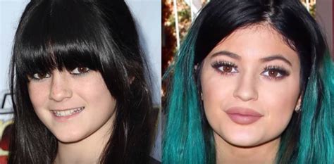Here's what kylie jenner looked like before veneers. Kylie Jenner before and after transformation - #Plastic ...