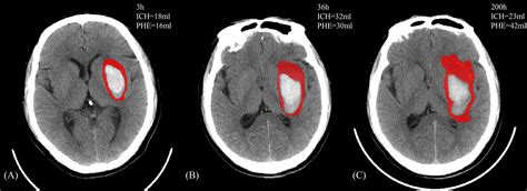 Frontiers Perihematomal Edema After Intracerebral Hemorrhage An