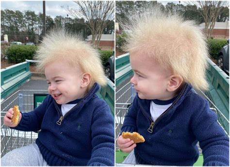 What Is Uncombable Hair Syndrome Rare Genetic Condition That This